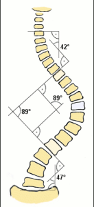 Scoliosis_cobb