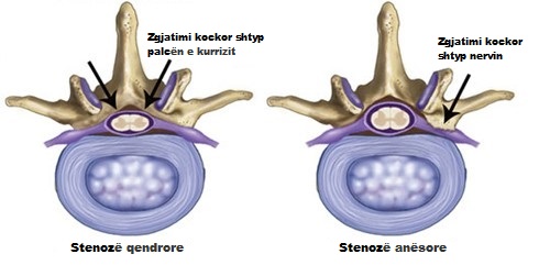 Udhëzimet e fizioterapistit për stenozën e shtyllës kurrizore (stenoza spinale)