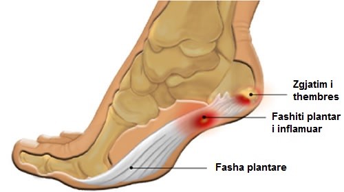 Çfarë është fashiti plantar?