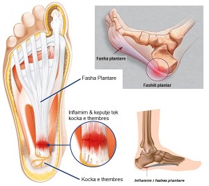 plantar-fasciitis
