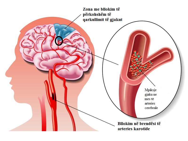 FIZIOTERAPIA PAS ISHEMISË CEREBRALE