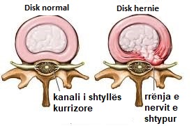 hernia