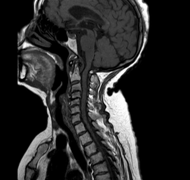 Dysphagia dhe Discopathy