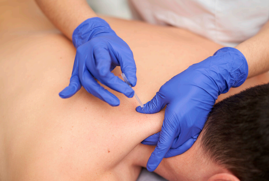 Dry Needling